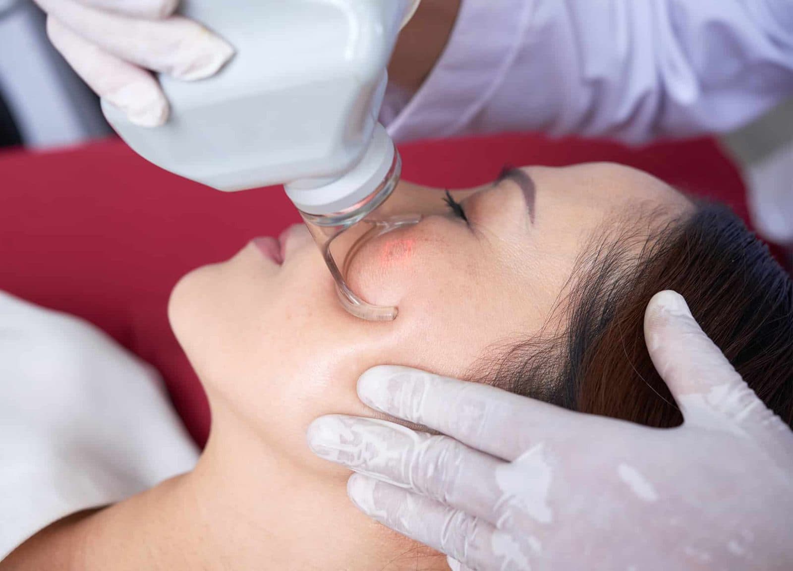 Which Acne Scar Treatment Is Right for Your Skin and Scar Type?