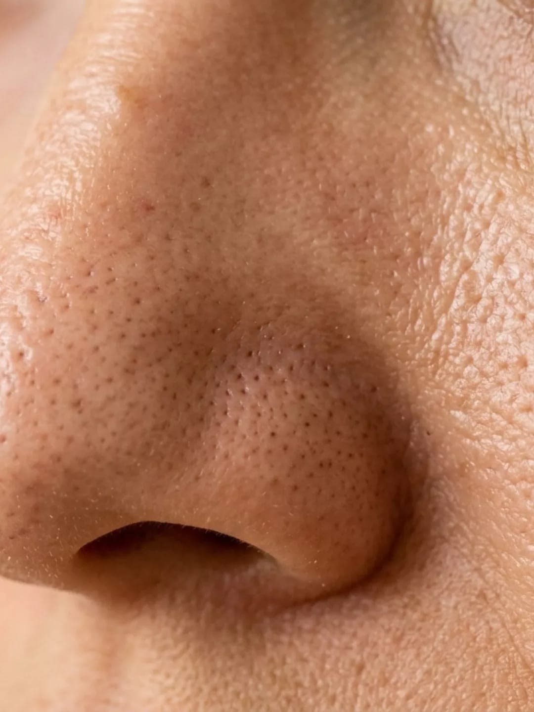 SkinPen® Precision — view 2