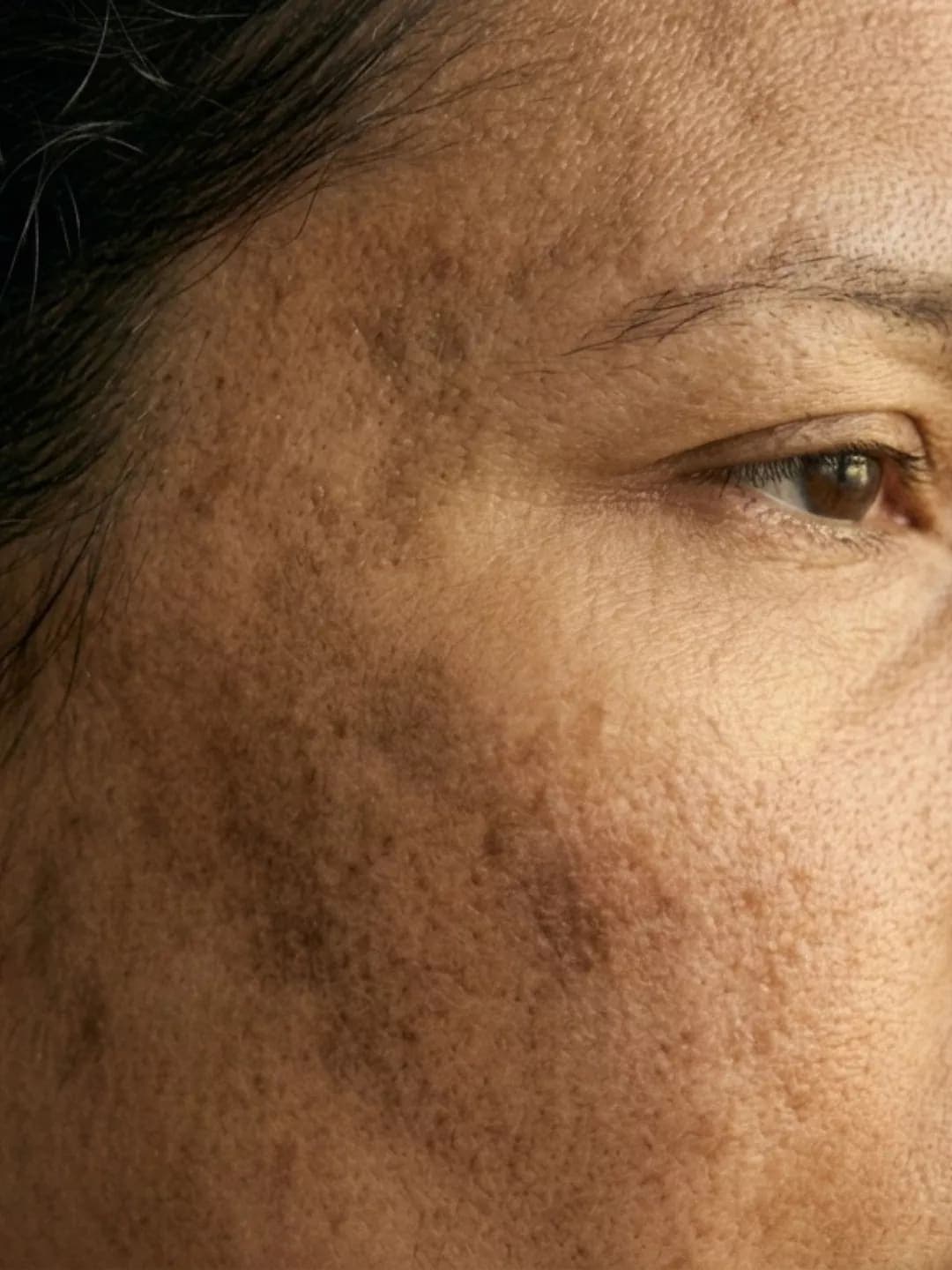 SkinPen® Precision